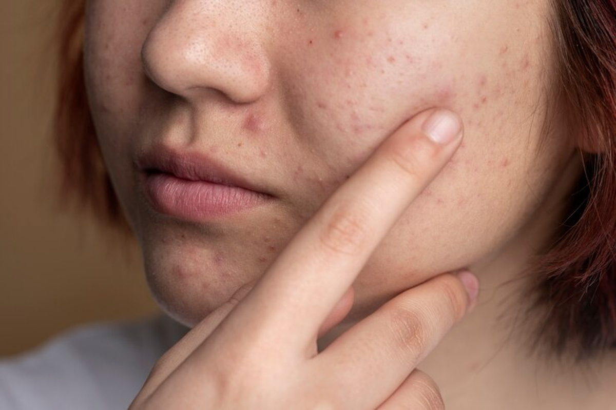 Techniques sûres pour percer un bouton sans risquer une infection